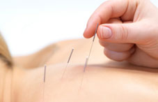 Someone receiving acupuncture Someone receiving acupuncture
