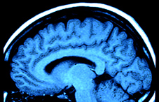 Brain mri Brain mri