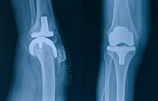 Knee replacement