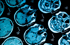 Mindfulness training holds promise for treating mood disorders partly because it may lead to changes in patients' brains, improving connectivity among some brain areas and changing tissue density in key regions, research suggests.