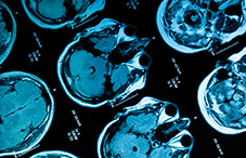 Brain imaging can predict how well psychotherapy may work for depression.