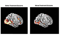 Social anxiety patients with more activity in their visual processing areas (left) responded better to cognitive behavioral therapy than patients with lower activity in those regions (right).