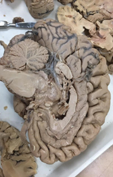Dissection of a human brain