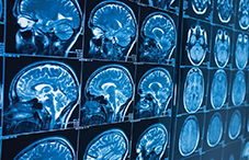 BRAIN initiative, researchers seek to detect structural changes in healthy brains that could predict the onset of Alzheimer’s disease.