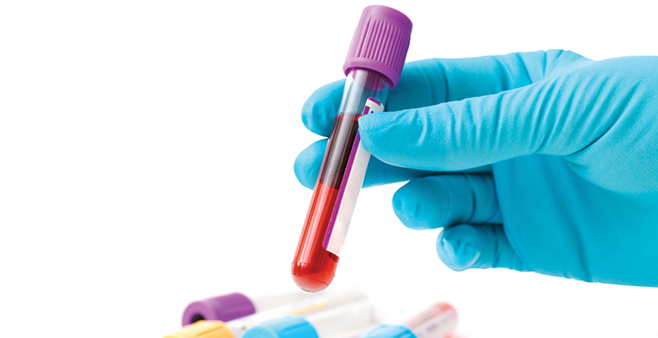 A new blood test could offer a faster, less expensive way to screen for Alzheimer’s disease.