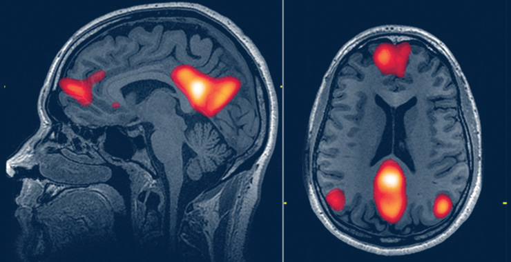 brain mri
