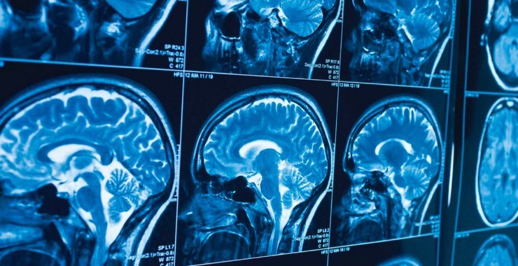 brain scans