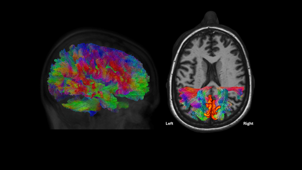 The brain of Dr. Temple Grandin