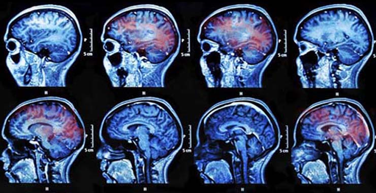 Concussion Test: Assessment Types & How to Interpret Results