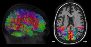 Black background with multicolored images of brain scans and the text Left Right